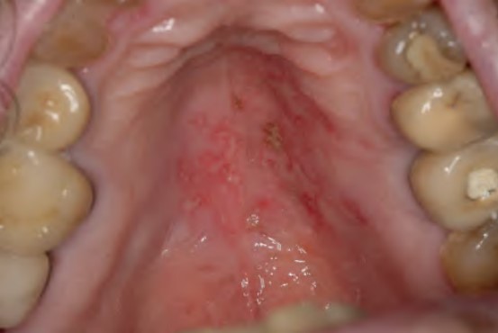 Herpes v ústach na tvrdom podnebí s viditeľnými pľuzgiermi a začervenaním.