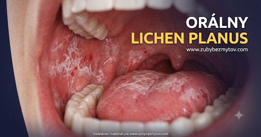 Pálenie v ústach. Čo je to orálny lichen?