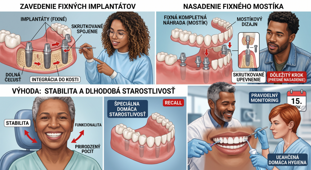 Edukatívna infografika rozdelená do 4 častí, ktorá vysvetľuje proces a výhody fixnej zubnej náhrady (mostíka) na implantátoch:
Hore vľavo (Zavedenie fixných implantátov): Anatomický prierez dolnej čeľuste ukazujúci proces integrácie zubných implantátov do kosti.
Hore vpravo (Nasadanie fixného mostíka): Ilustrácia nasadenia celkovej zubnej náhrady (mostíka) na implantáty pomocou skrutkovaného upevnenia.
Dole vľavo (Výhoda: Stabilita a dlhodobá starostlivosť): Usmievavá pacientka a zobrazenie špeciálnej domácej starostlivosti o pevný mostík s dôrazom na stabilitu, funkcionalitu a prirodzený pocit.
Dole vpravo (Pravidelný monitoring a hygiena): Zubný lekár a dentálna hygienička pri kontrole a čistení fixnej náhrady (Recall) spolu so zobrazením kalendára pripomínajúceho pravidelné kontroly.