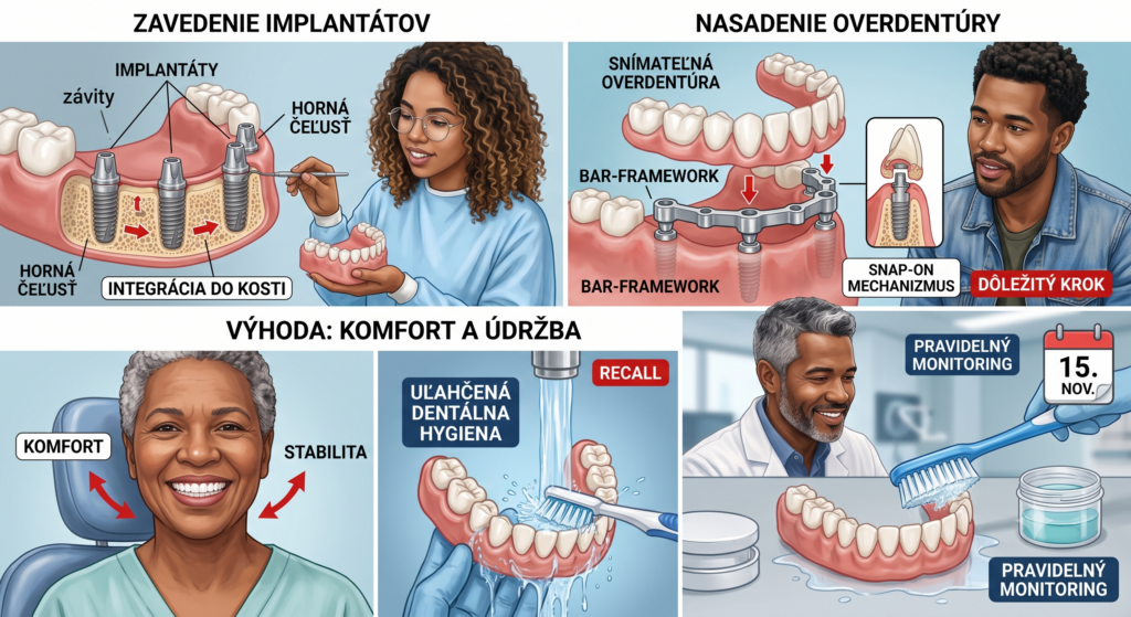 Alt text:
Edukatívna infografika rozdelená do 4 častí, ktorá vysvetľuje postup a výhody snímateľnej hybridnej protézy (overdentúry) na implantátoch:
Hore vľavo (Zavedenie implantátov): Anatomické zobrazenie kosti čeluste so zavedenými zubnými implantátmi a popisom procesu ich integrácie do kosti.
Hore vpravo (Nasadenie overdentúry): Schéma ukazujúca kovovú strmeňovú konštrukciu (bar-framework) upevnenú na implantátoch a nasadanie snímateľnej overdentúry pomocou zacvakávacieho (snap-on) mechanizmu.
Dole vľavo (Výhoda: Komfort a údržba): Spokojná usmievavá pacientka so zvýraznením stability a komfortu, spolu s ilustráciou ľahkého čistenia snímateľnej protézy pod tečúcou vodou.
Dole vpravo (Pravidelný monitoring): Zubný lekár pri kontrole a inštruktáži dentálnej hygieny (Recall), s dôrazom na čistenie protézy a pravidelné preventívne prehliadky symbolizované kalendárom.
